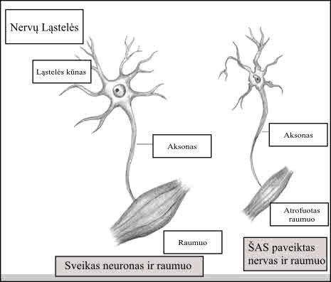 Motorinio neurono ligos